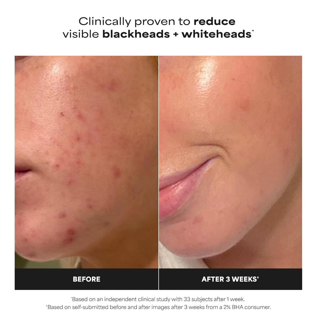 Paulas Choice--SKIN PERFECTING 2% BHA Liquid Salicylic Acid Exfoliant--Facial Exfoliant for Blackheads, Enlarged Pores, Wrinkles & Fine Lines, 4 oz Bottle