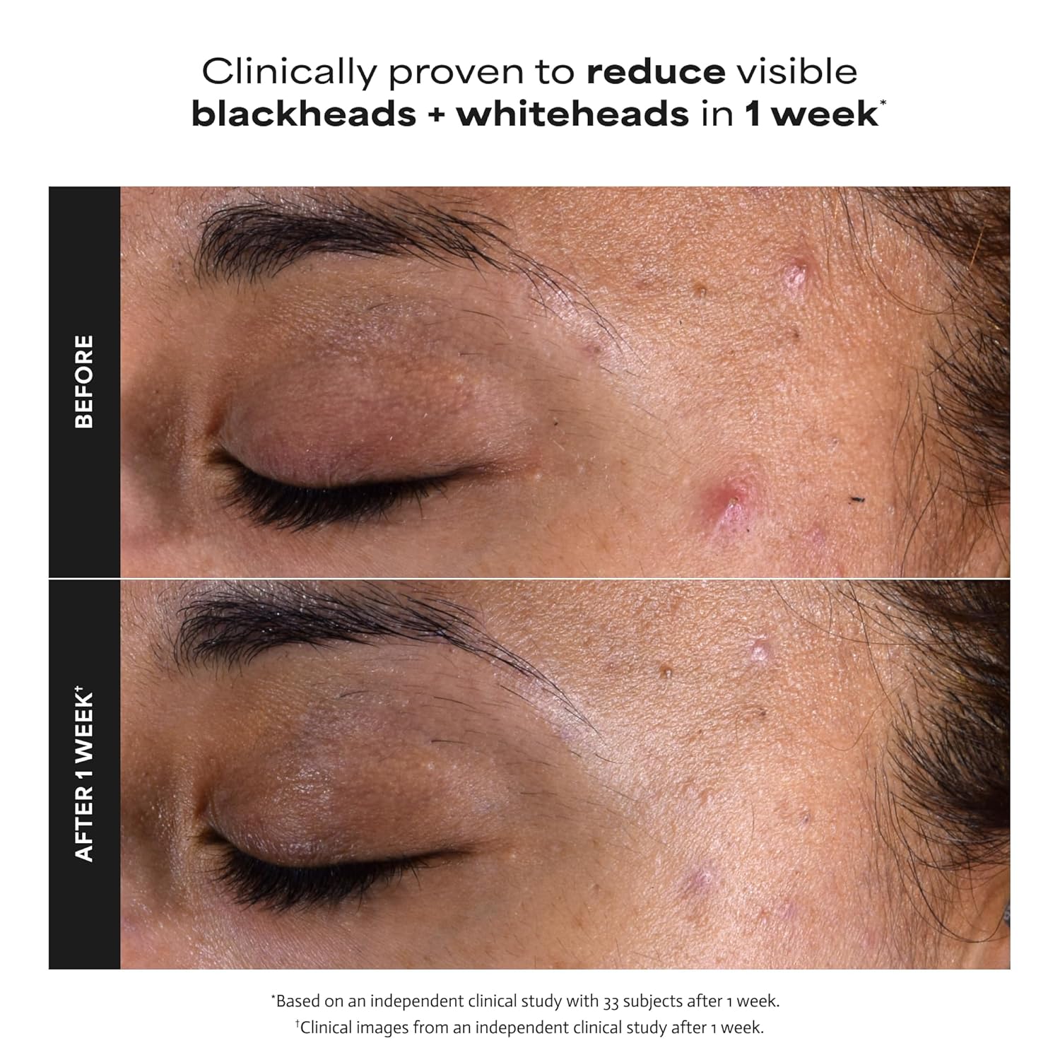 Paulas Choice--SKIN PERFECTING 2% BHA Liquid Salicylic Acid Exfoliant--Facial Exfoliant for Blackheads, Enlarged Pores, Wrinkles & Fine Lines, 4 oz Bottle